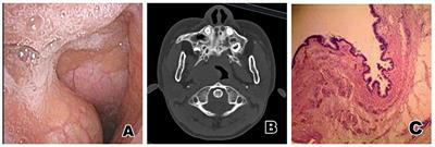 A Clinical Analysis of Pharyngeal Bronchogenic Cysts in the Pharynx of Children